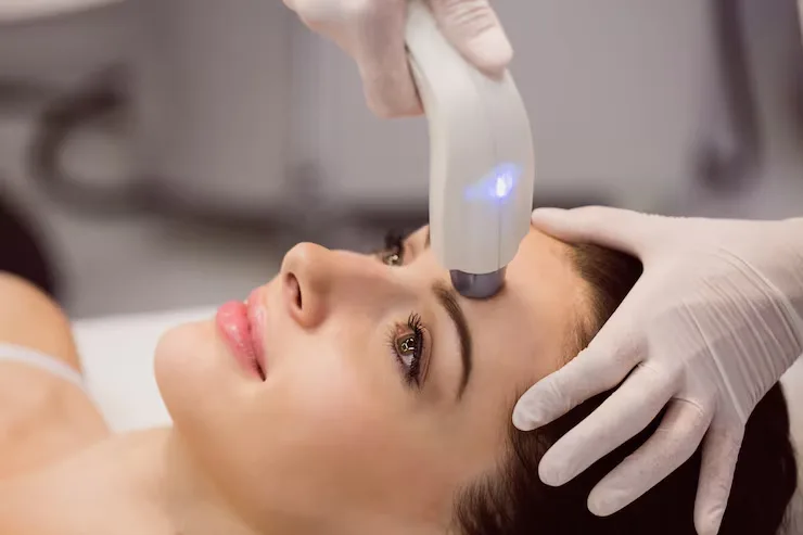 CO2 Fractional Laser Resurfacing