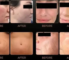 before after img