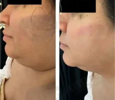 before after img
