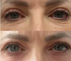 Skin before after img