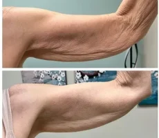 arm