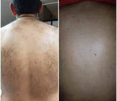 Hair Removal