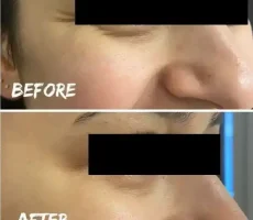 before after img