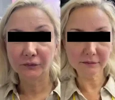 before after img