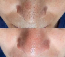 blackhead