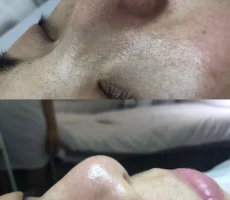 facial before after img