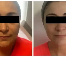 before after img