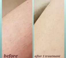 hair removal