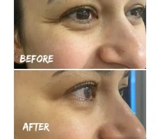 wrinkle before after img